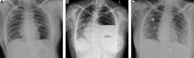Postoperative diaphragmatic hernia following endoscopic thoracic sympathectomy for primary palmar hyperhidrosis: A case report